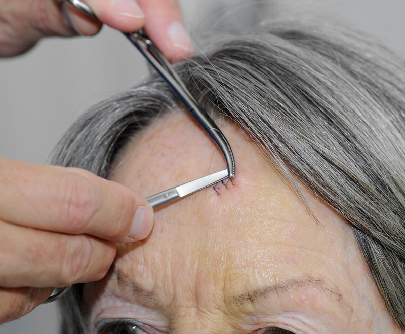 Hauttumoren Thun Stouthandel